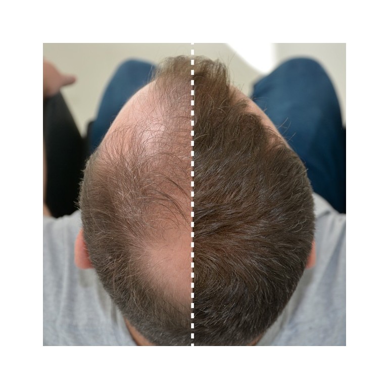 FIBRAS CAPILARES KERATINA 25 gr FIBRAS CAPILARES KERATINA 25 gr